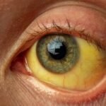 कावीळ Kavil: लक्षणे, कारणे आणि उपाय Symptoms